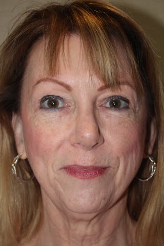Rhinoplasty Before & After Gallery - Patient 53821256 - Image 4