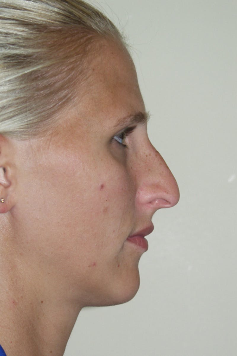 Rhinoplasty Before & After Gallery - Patient 53821279 - Image 1