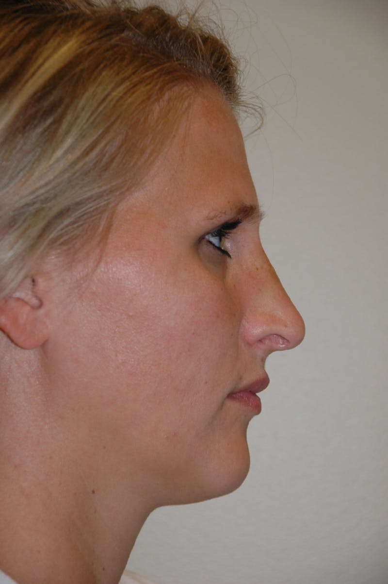 Rhinoplasty Before & After Gallery - Patient 53821279 - Image 2