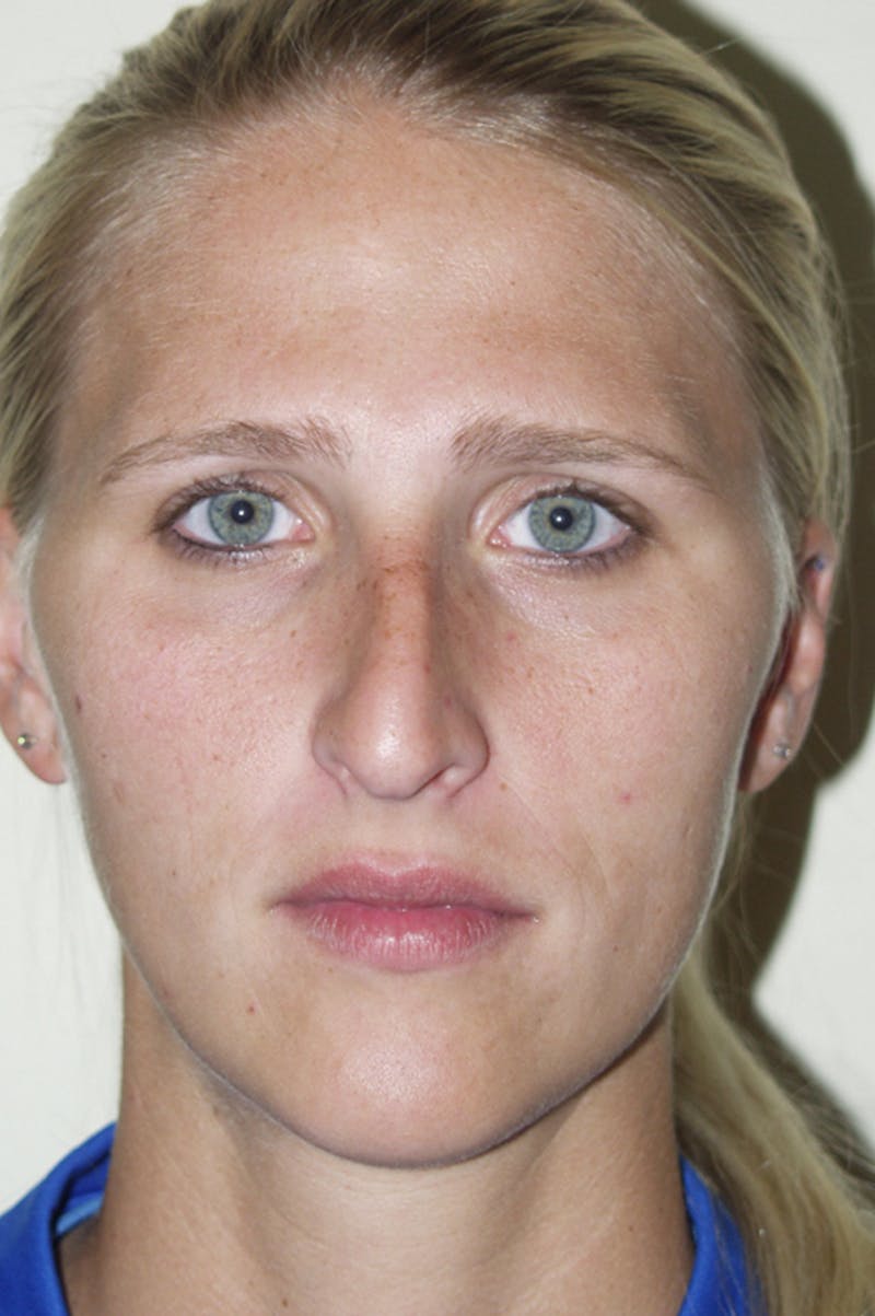 Rhinoplasty Before & After Gallery - Patient 53821279 - Image 3