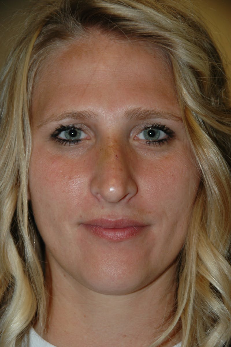 Rhinoplasty Before & After Gallery - Patient 53821279 - Image 4