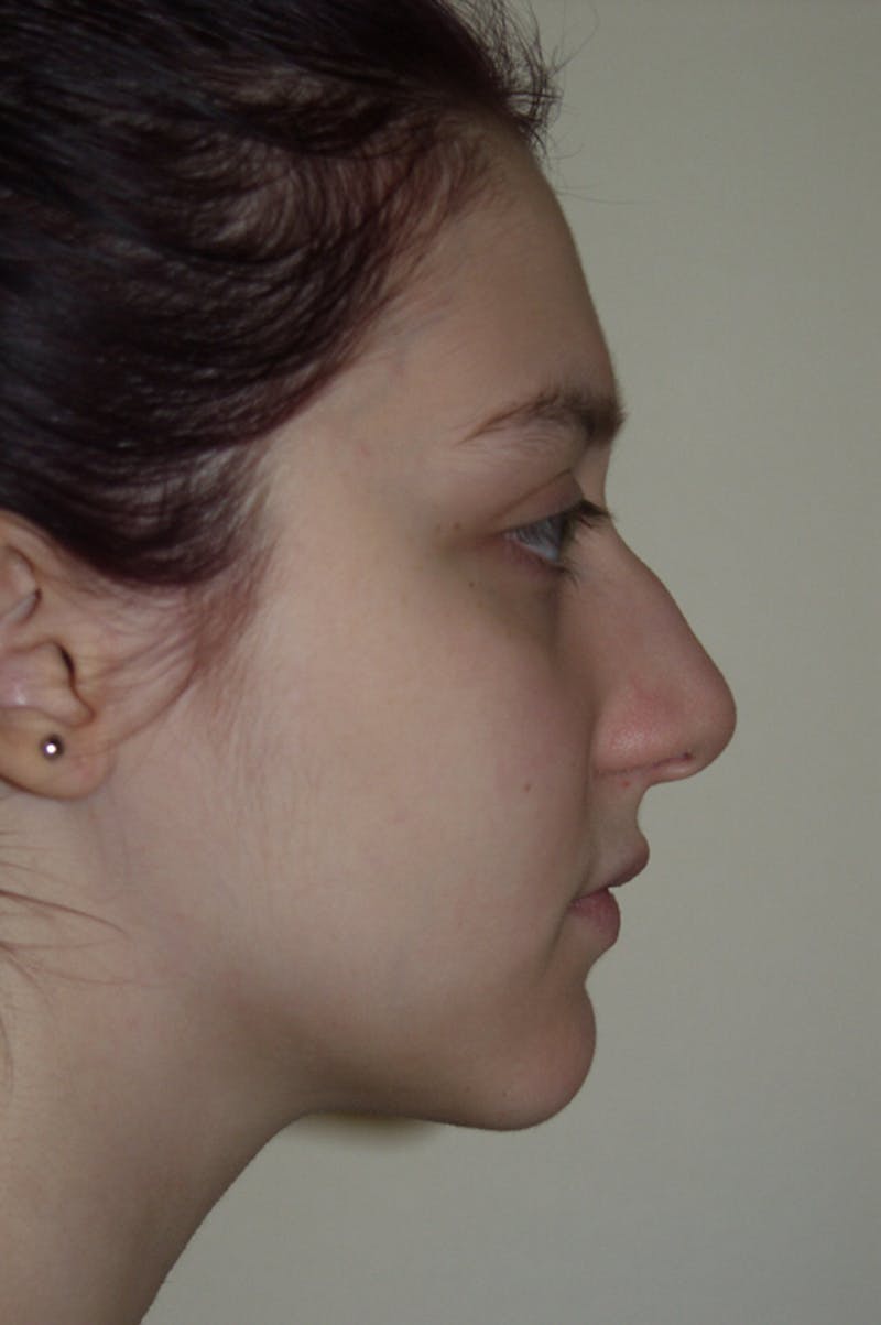 Rhinoplasty Before & After Gallery - Patient 53821309 - Image 1