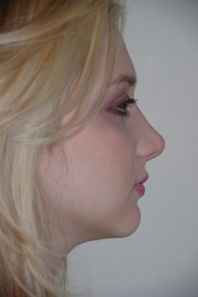 Rhinoplasty Before & After Gallery - Patient 53821309 - Image 2