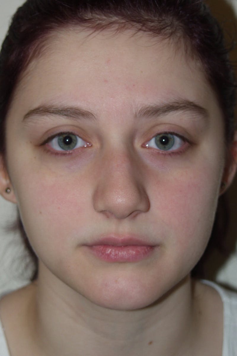 Rhinoplasty Before & After Gallery - Patient 53821309 - Image 3