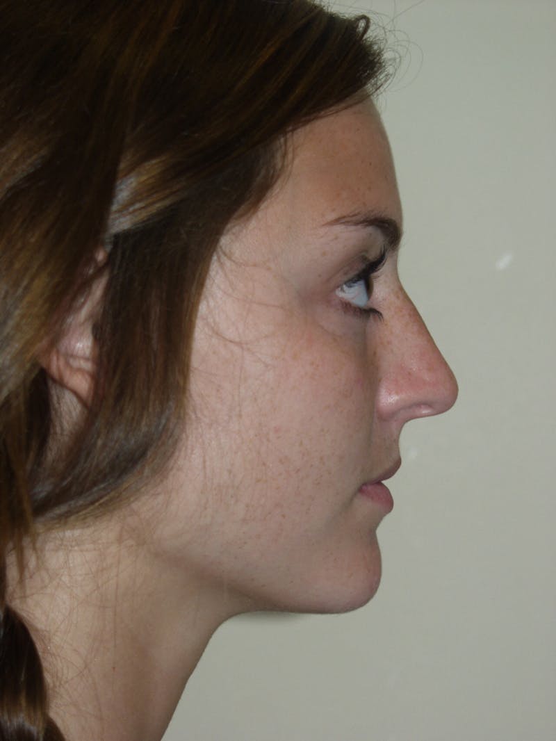 Rhinoplasty Before & After Gallery - Patient 53821324 - Image 1