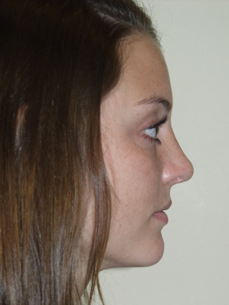 Rhinoplasty Before & After Gallery - Patient 53821324 - Image 2