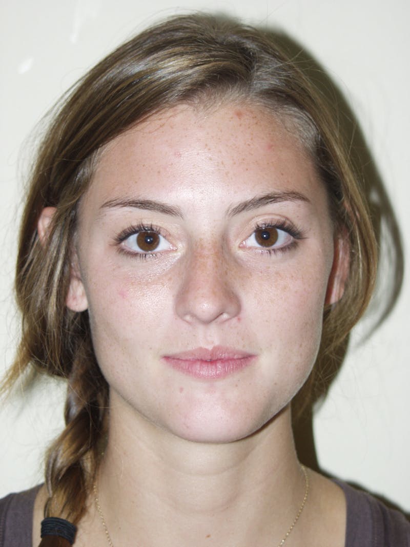Rhinoplasty Before & After Gallery - Patient 53821324 - Image 3