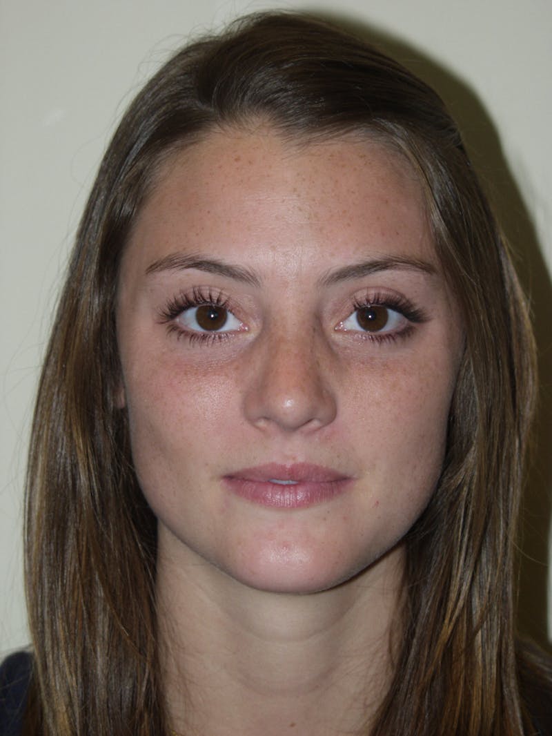 Rhinoplasty Before & After Gallery - Patient 53821324 - Image 4