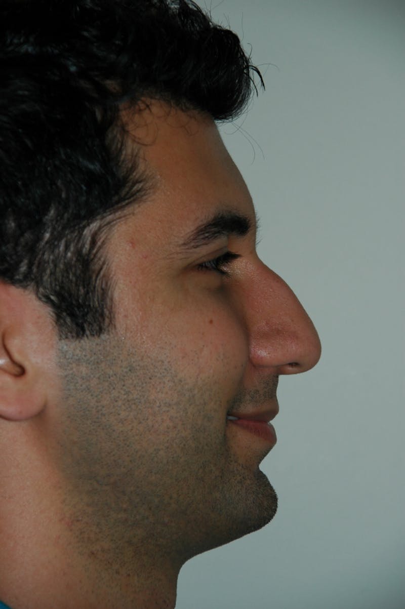 Rhinoplasty Before & After Gallery - Patient 53821365 - Image 1