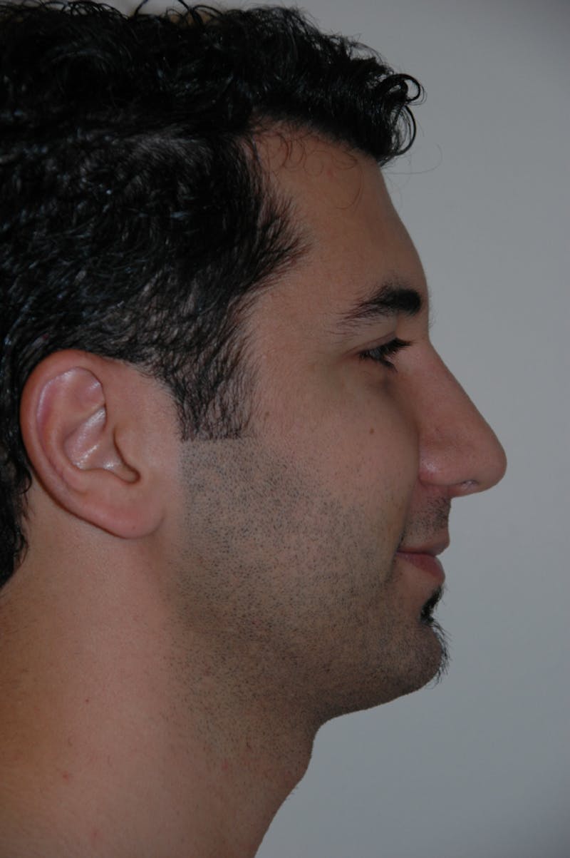 Rhinoplasty Before & After Gallery - Patient 53821365 - Image 2