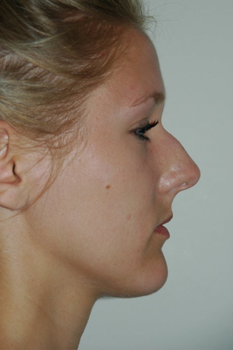 Rhinoplasty Before & After Gallery - Patient 53822175 - Image 1