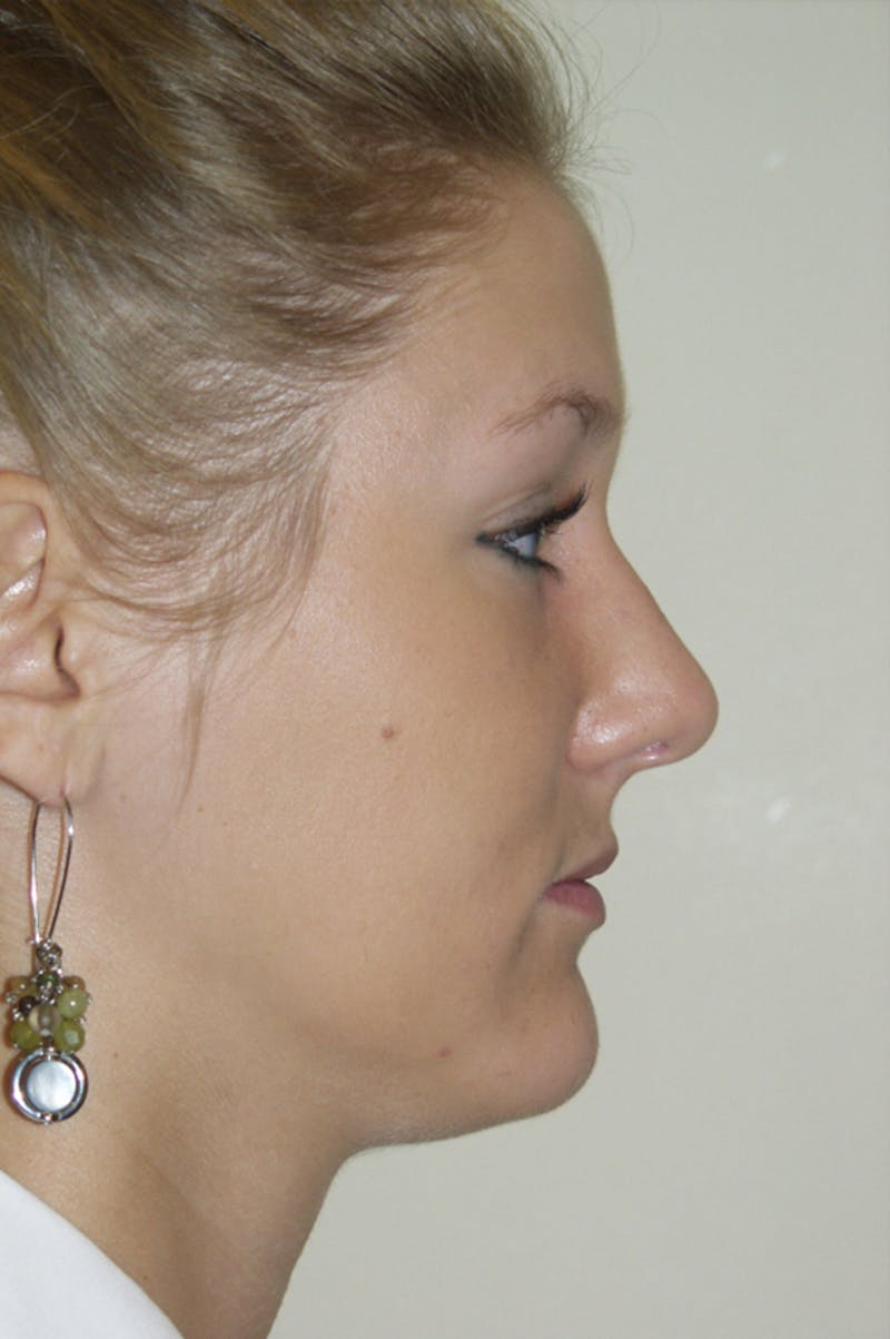 Rhinoplasty Before & After Gallery - Patient 53822175 - Image 2
