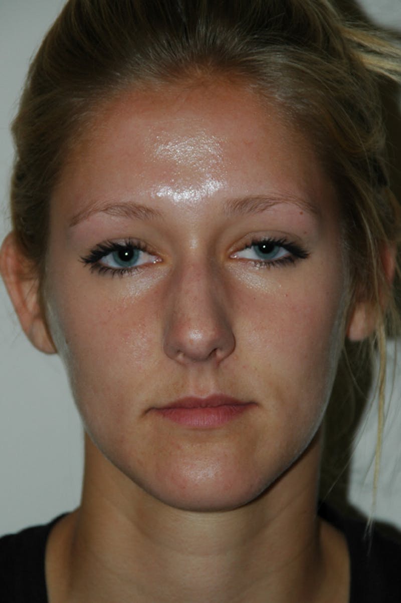 Rhinoplasty Before & After Gallery - Patient 53822175 - Image 3