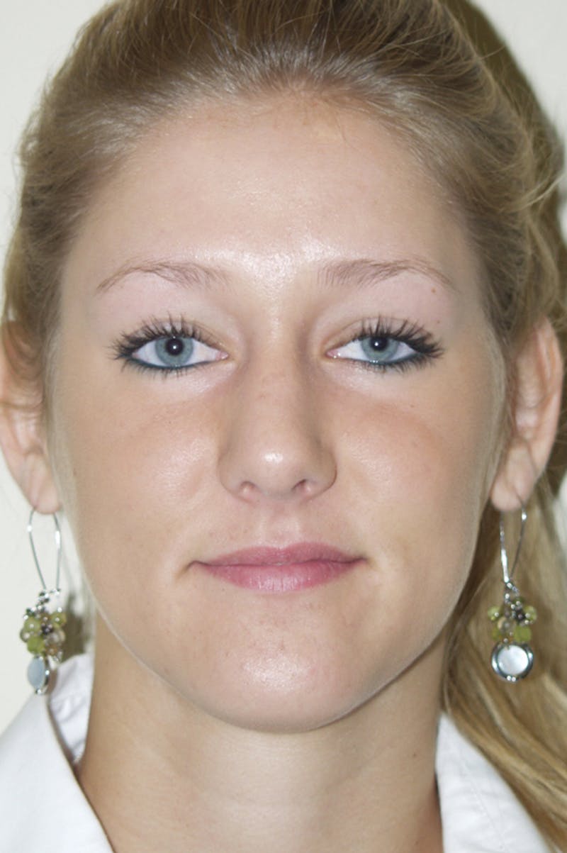 Rhinoplasty Before & After Gallery - Patient 53822175 - Image 4