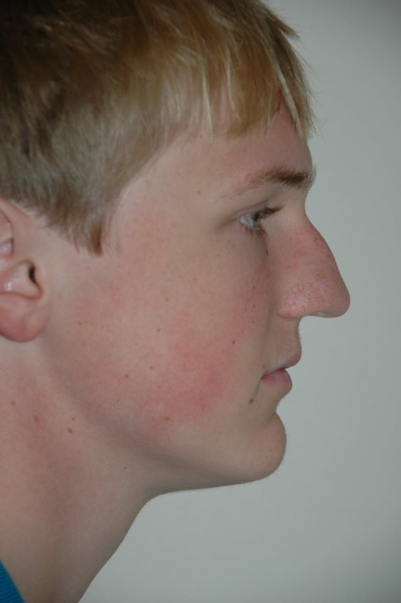 Rhinoplasty Before & After Gallery - Patient 53822189 - Image 1