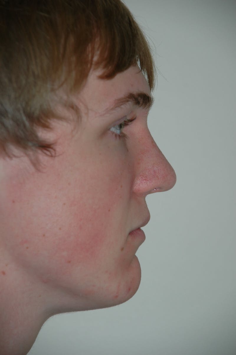 Rhinoplasty Before & After Gallery - Patient 53822189 - Image 2