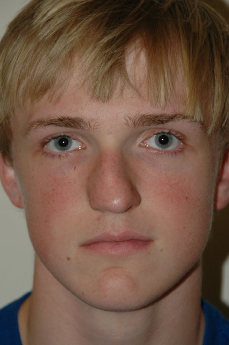 Rhinoplasty Before & After Gallery - Patient 53822189 - Image 3