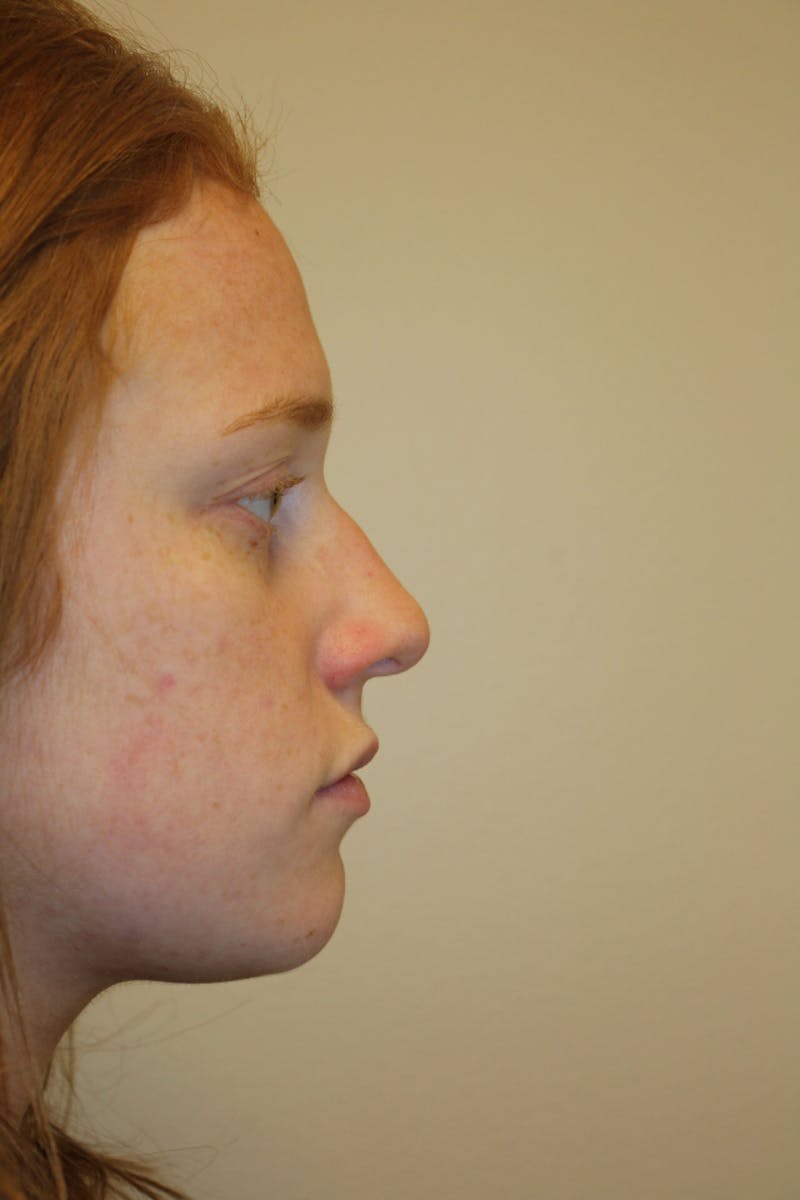 Rhinoplasty Before & After Gallery - Patient 53822984 - Image 1