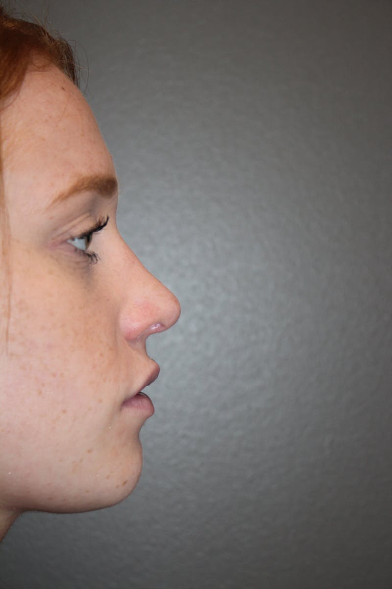 Rhinoplasty Before & After Gallery - Patient 53822984 - Image 2