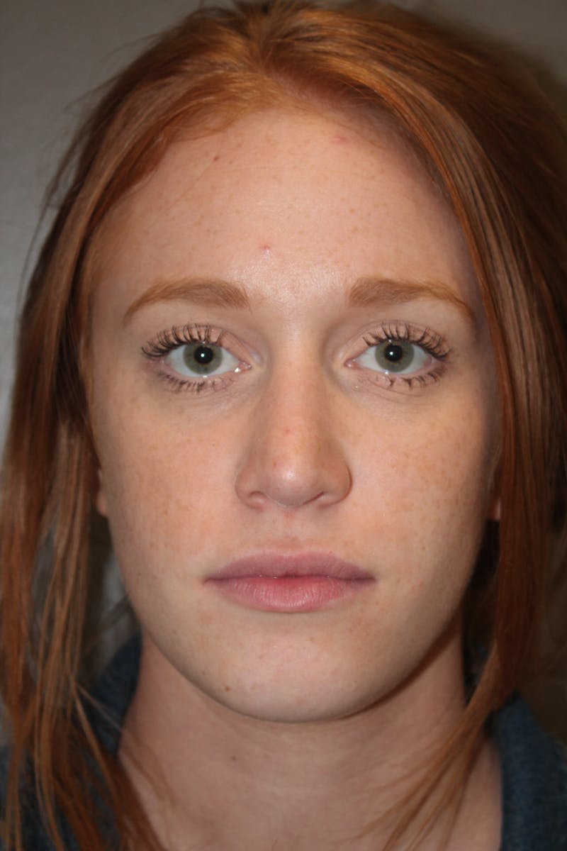 Rhinoplasty Before & After Gallery - Patient 53822984 - Image 4