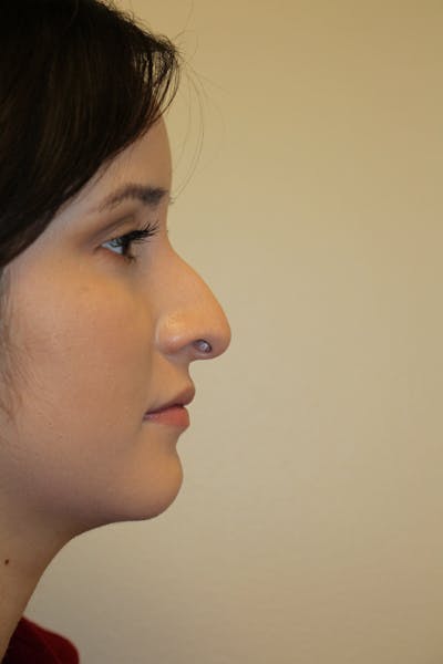 Rhinoplasty Before & After Gallery - Patient 53822985 - Image 1