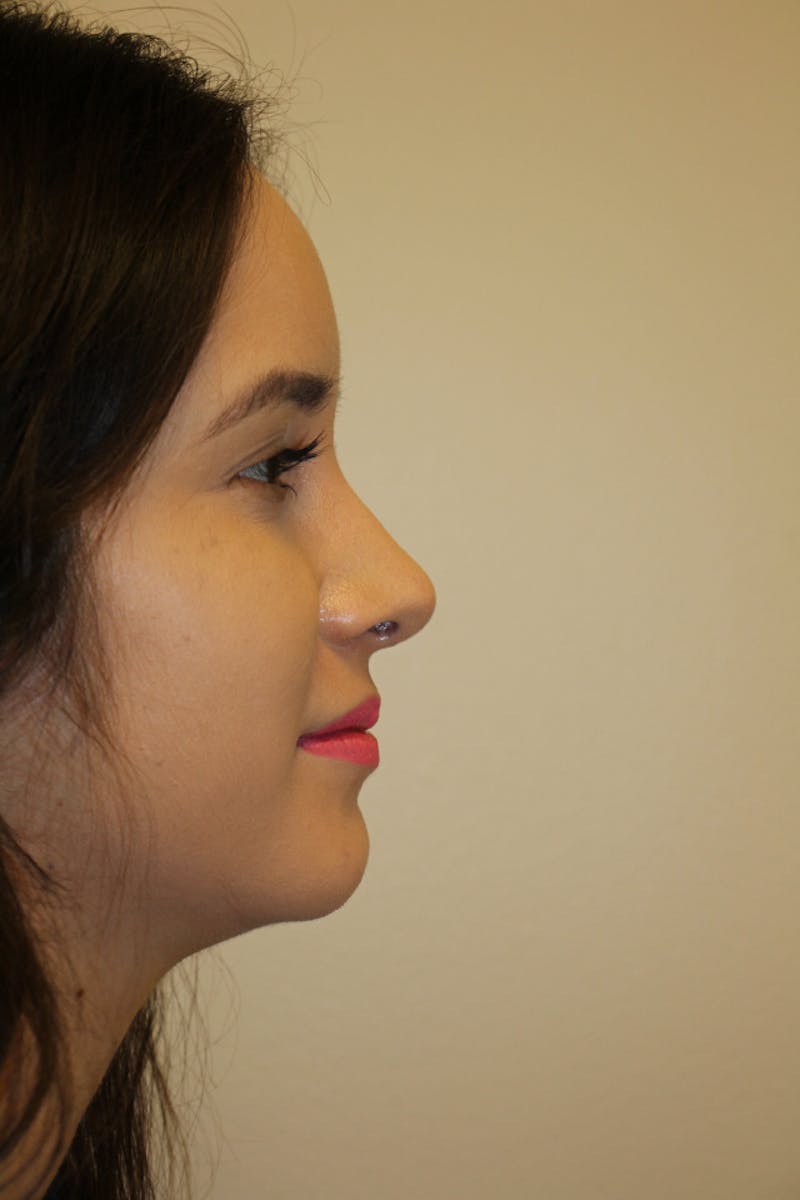Rhinoplasty Before & After Gallery - Patient 53822985 - Image 2