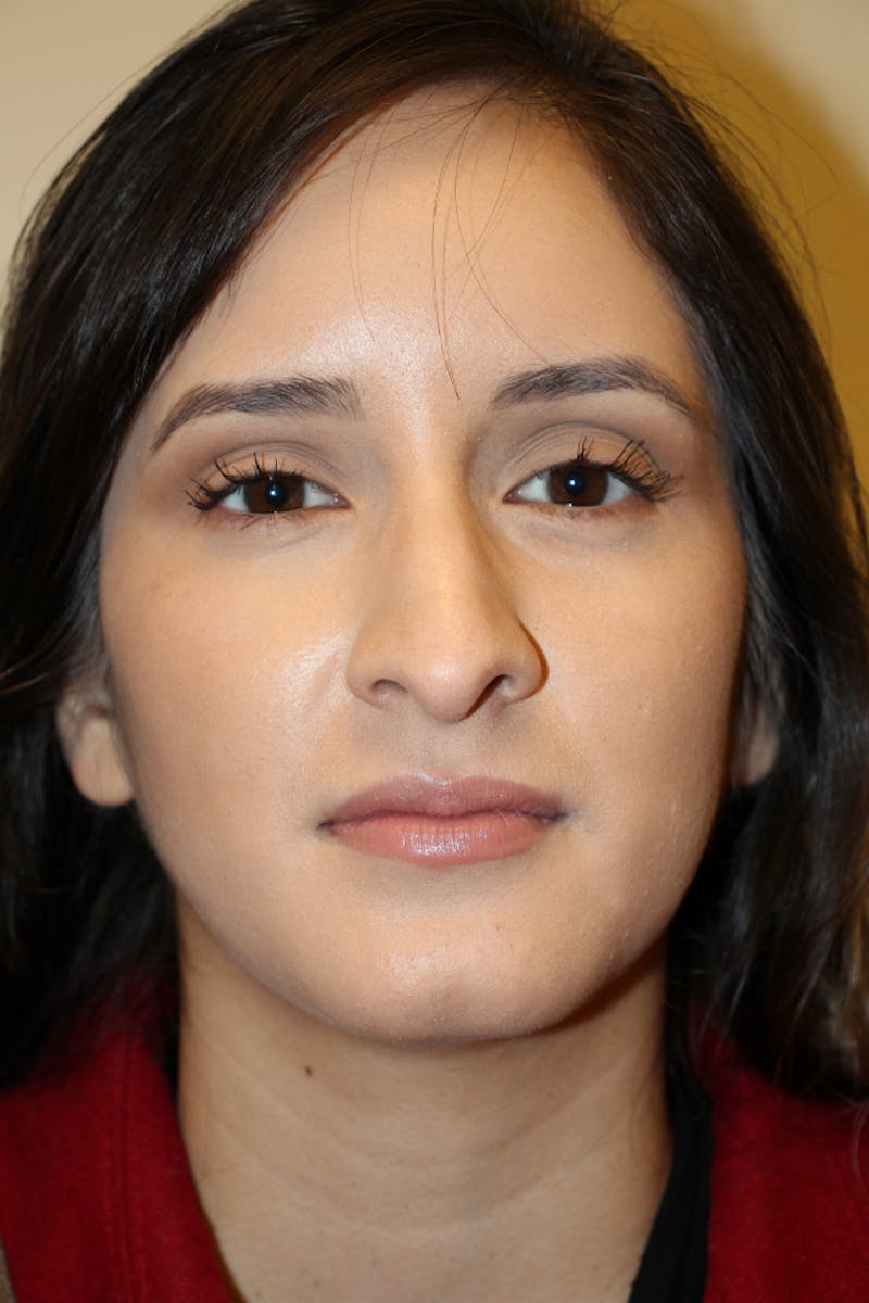 Rhinoplasty Before & After Gallery - Patient 53822985 - Image 3