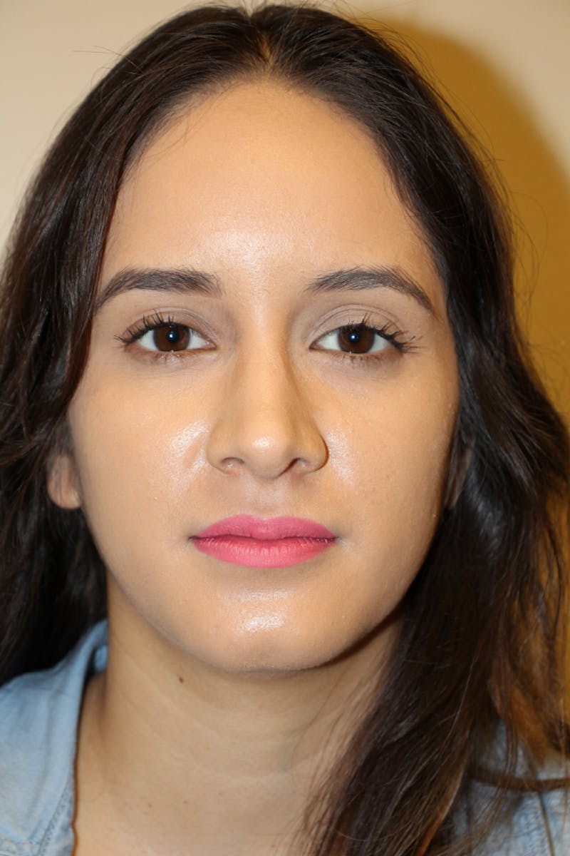 Rhinoplasty Before & After Gallery - Patient 53822985 - Image 4