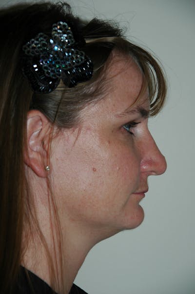 Rhinoplasty Before & After Gallery - Patient 53823276 - Image 1