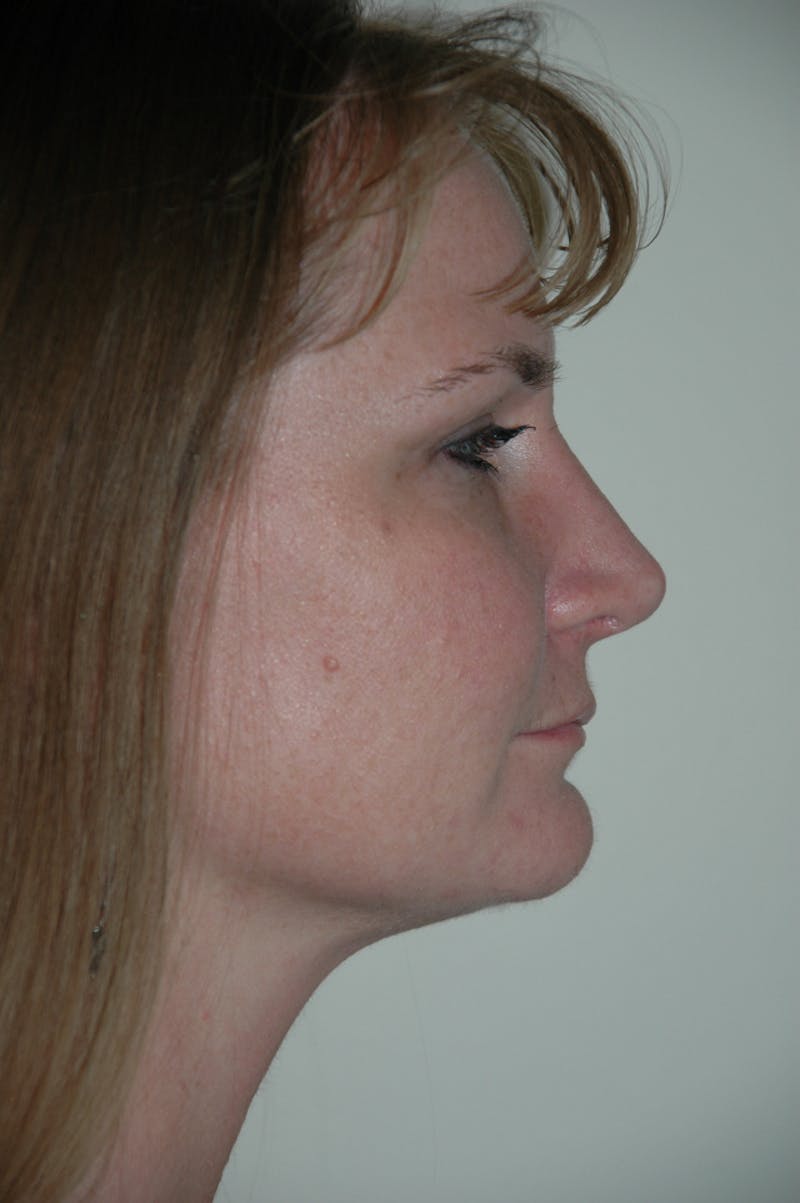 Rhinoplasty Before & After Gallery - Patient 53823276 - Image 2