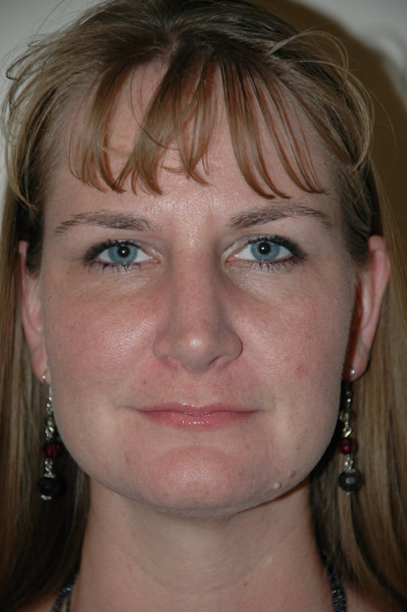 Rhinoplasty Before & After Gallery - Patient 53823276 - Image 4