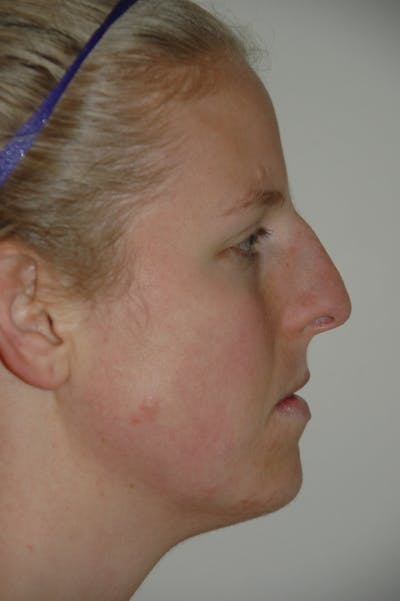Rhinoplasty Before & After Gallery - Patient 53823341 - Image 1