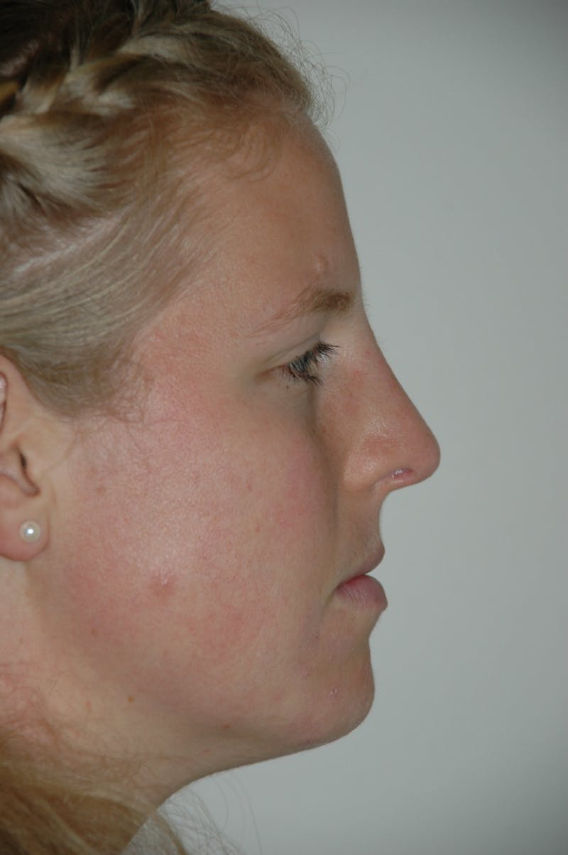 Rhinoplasty Before & After Gallery - Patient 53823341 - Image 2