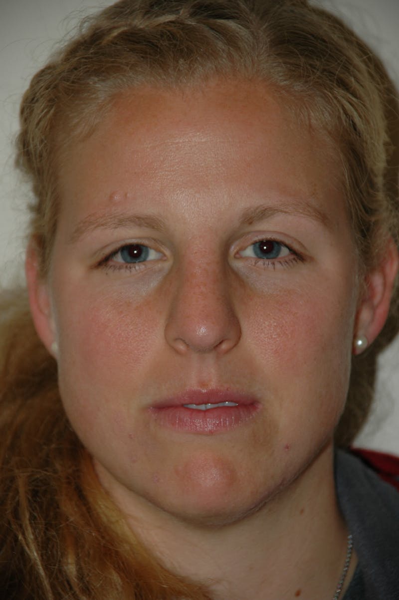 Rhinoplasty Before & After Gallery - Patient 53823341 - Image 4