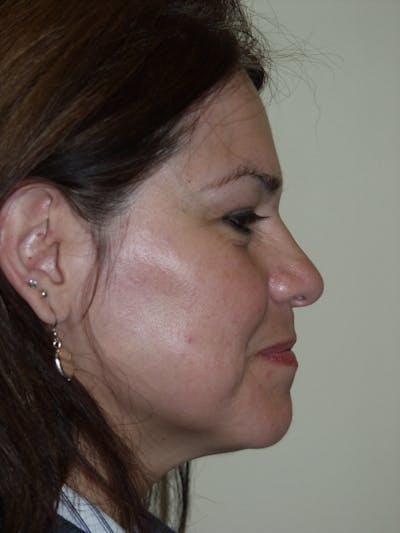 Rhinoplasty Before & After Gallery - Patient 53823342 - Image 1