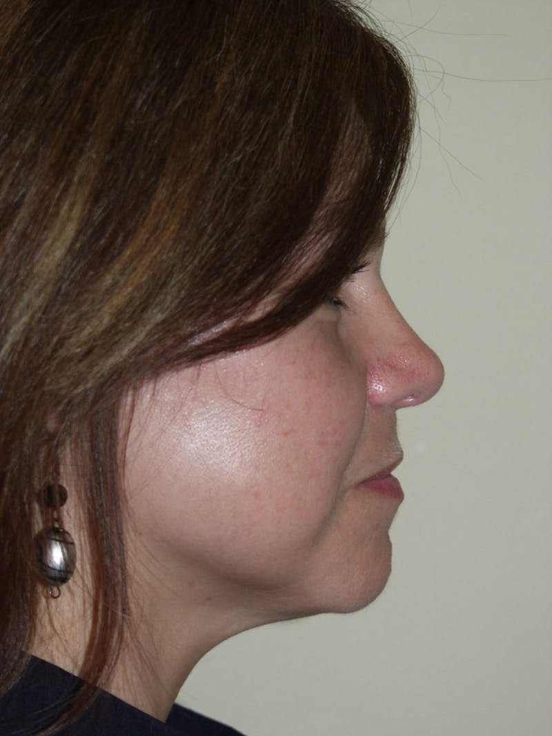Rhinoplasty Before & After Gallery - Patient 53823342 - Image 2