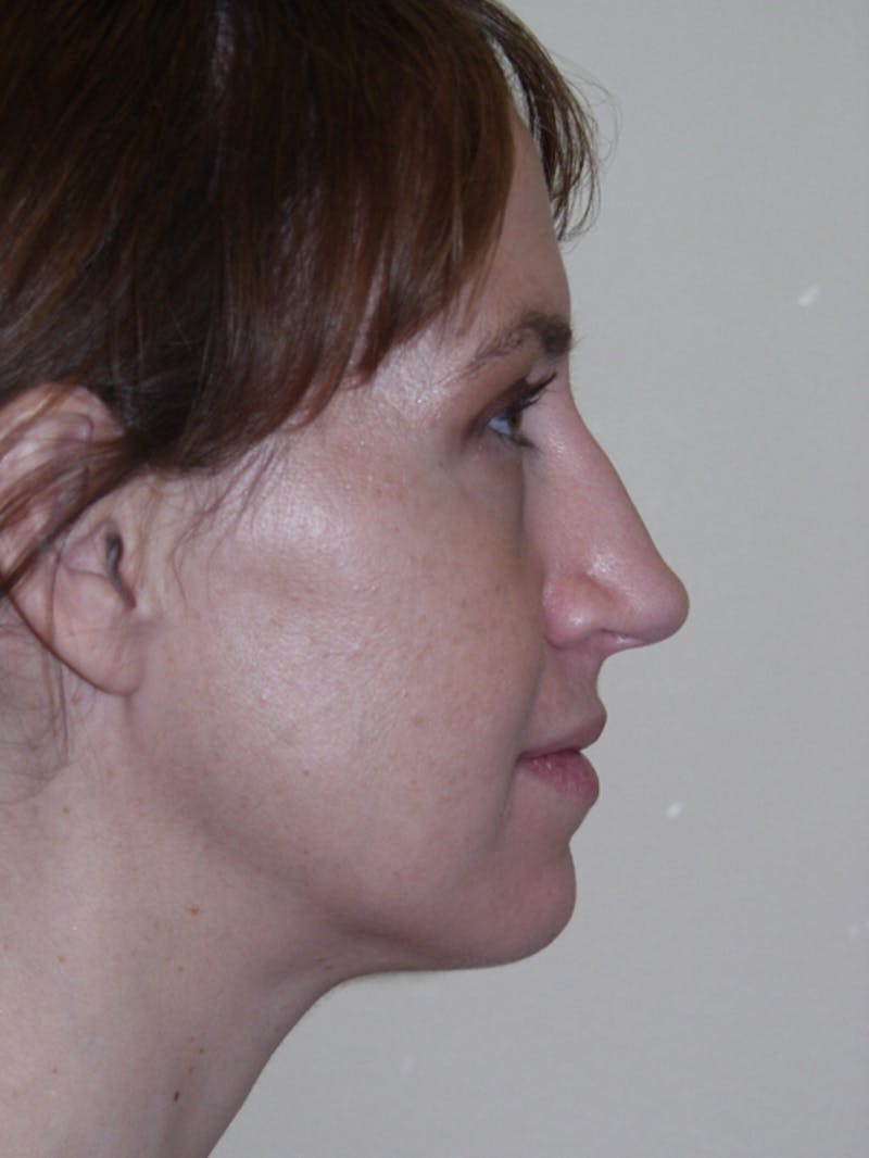 Rhinoplasty Before & After Gallery - Patient 53823343 - Image 1