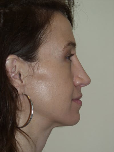 Rhinoplasty Before & After Gallery - Patient 53823343 - Image 2
