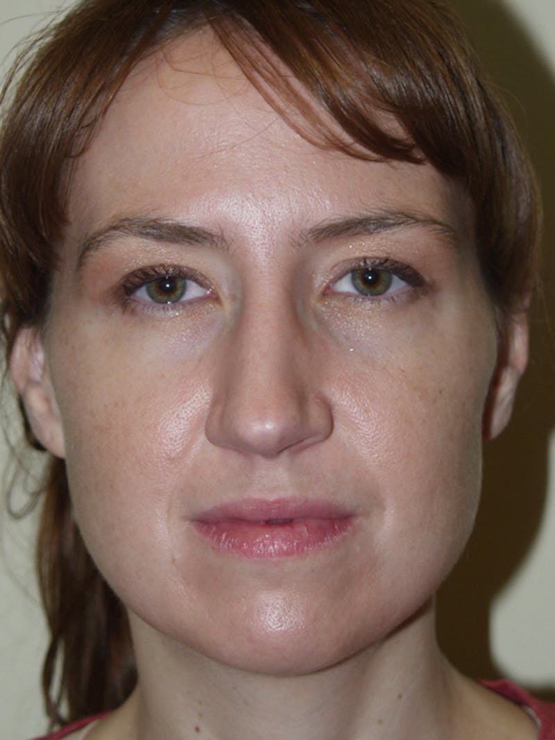 Rhinoplasty Before & After Gallery - Patient 53823343 - Image 3