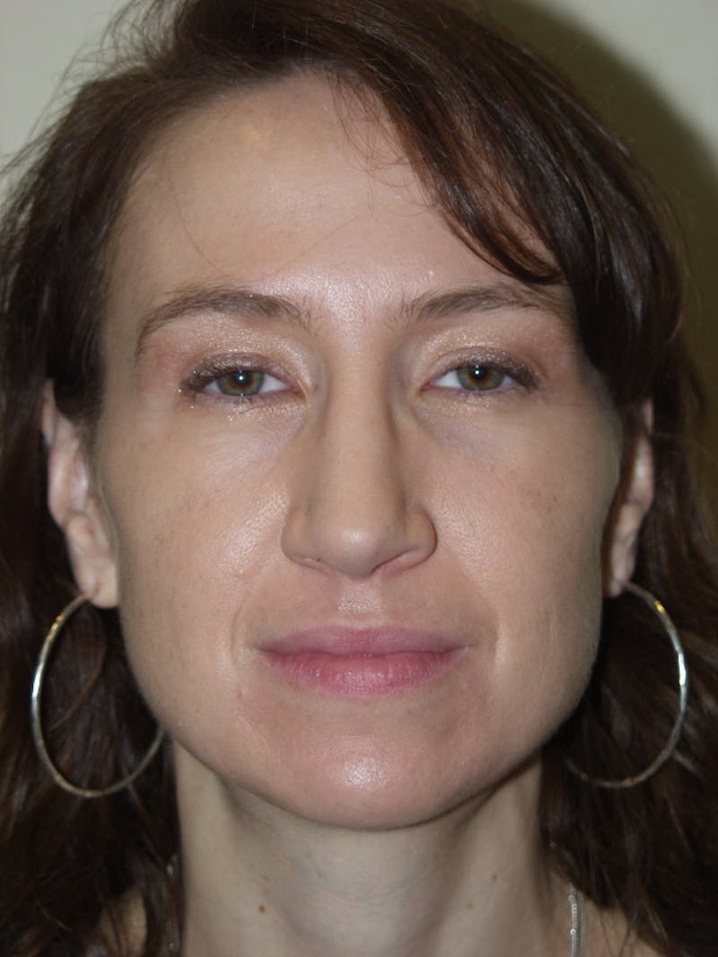 Rhinoplasty Before & After Gallery - Patient 53823343 - Image 4