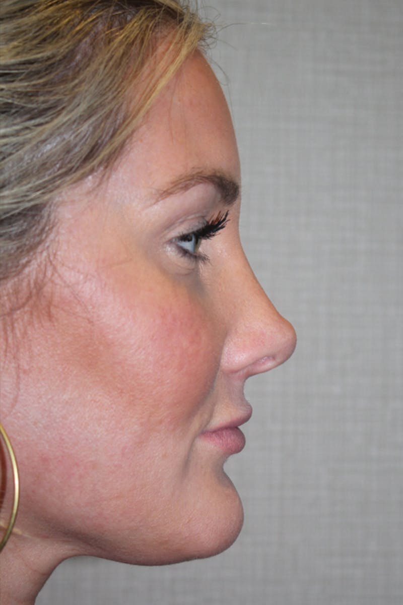 Rhinoplasty Before & After Gallery - Patient 53823811 - Image 2