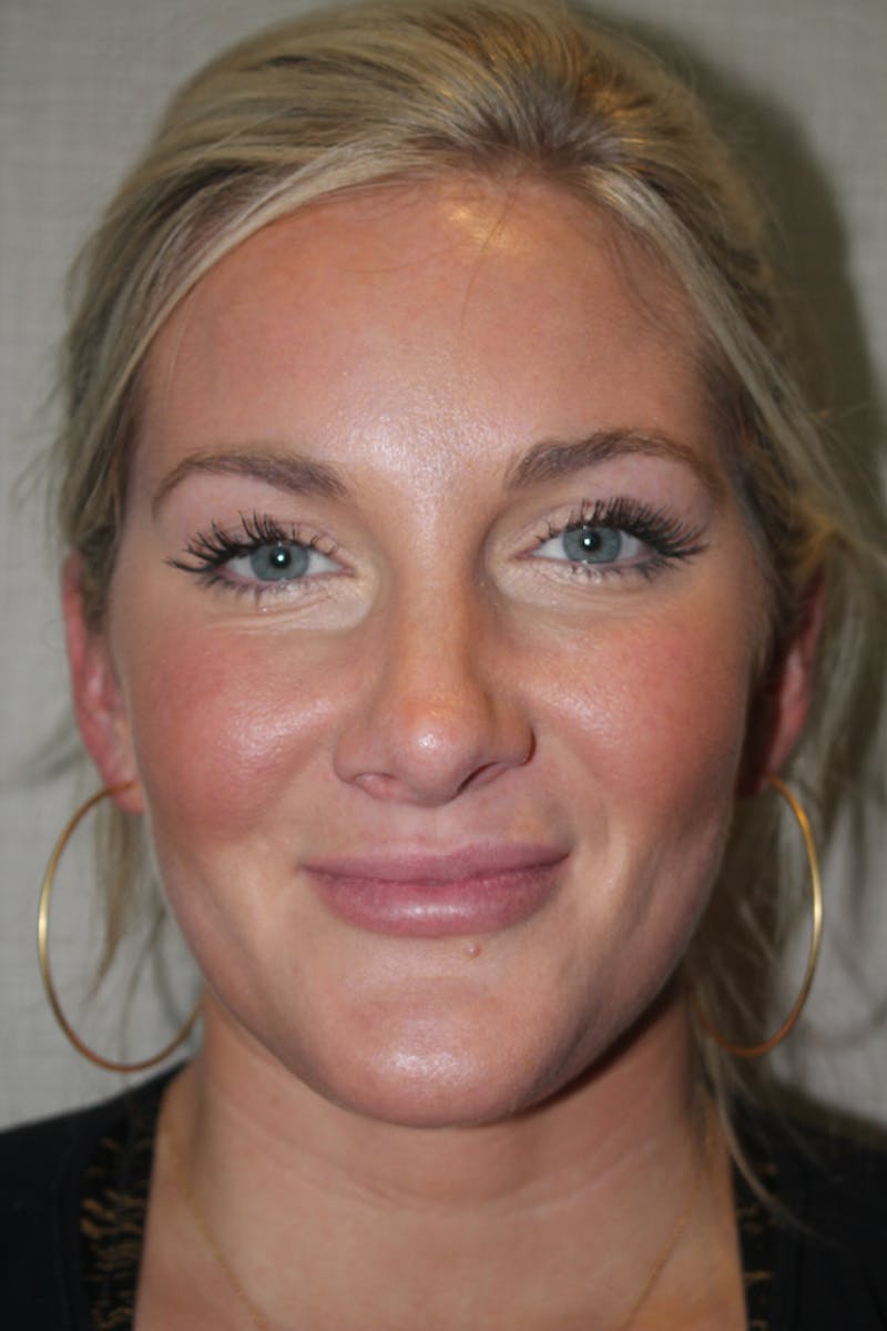 Rhinoplasty Before & After Gallery - Patient 53823811 - Image 4