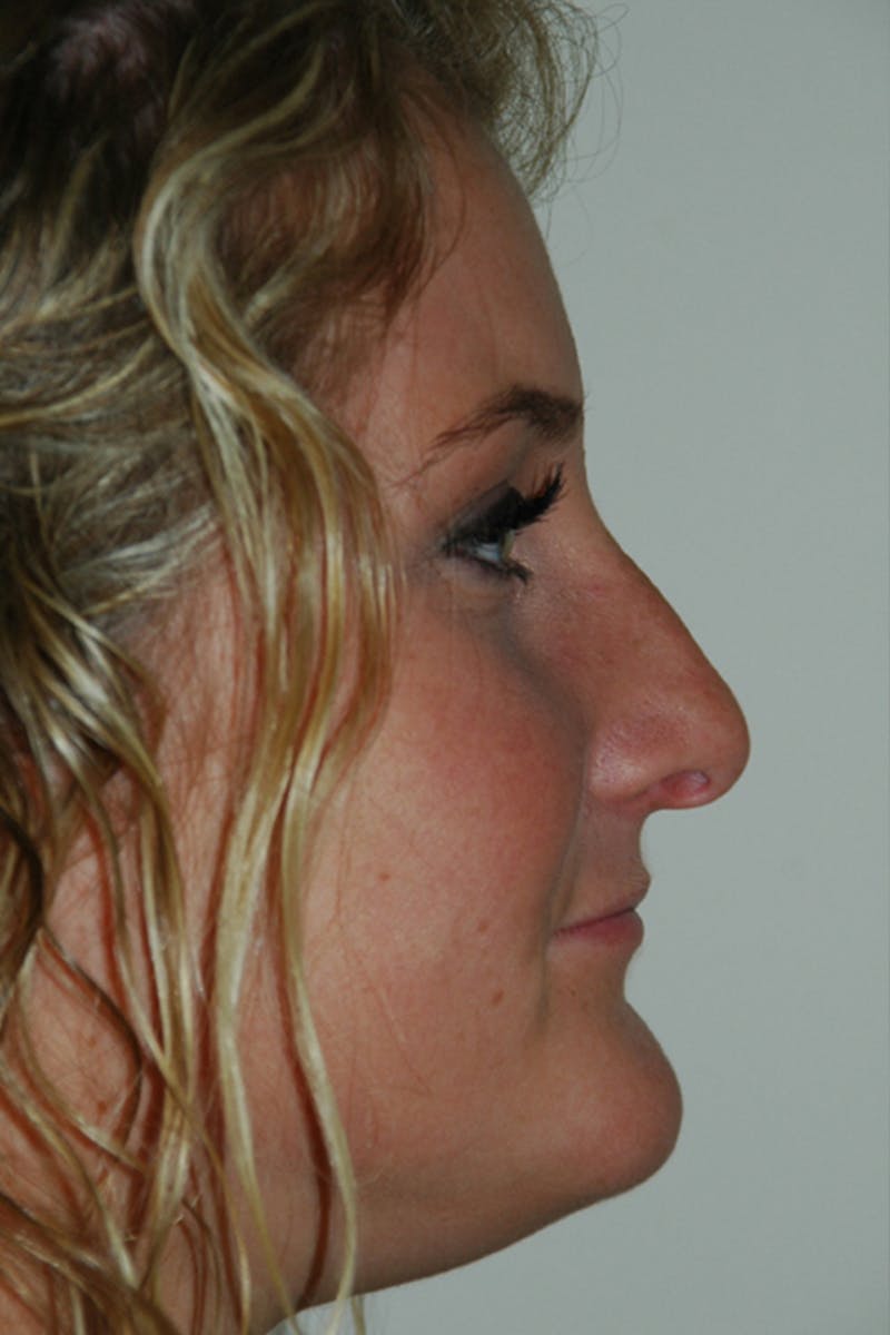Rhinoplasty Before & After Gallery - Patient 53823811 - Image 1