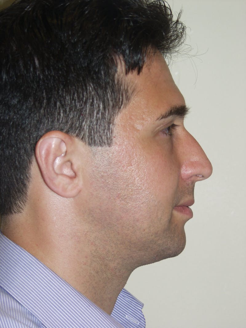 Rhinoplasty Before & After Gallery - Patient 53824004 - Image 1