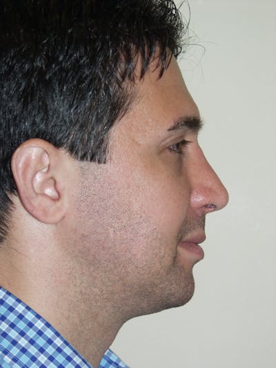 Rhinoplasty Before & After Gallery - Patient 53824004 - Image 2