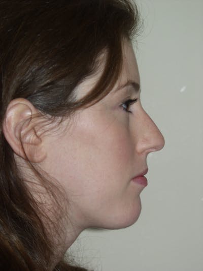 Rhinoplasty Before & After Gallery - Patient 53824005 - Image 1
