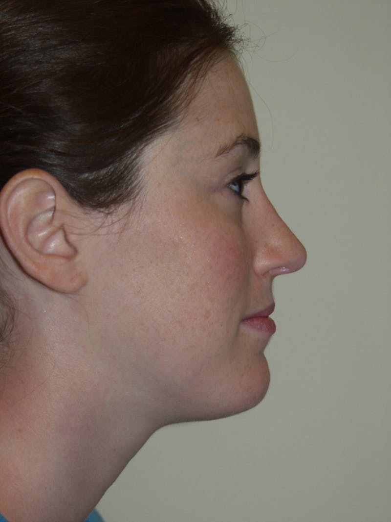 Rhinoplasty Before & After Gallery - Patient 53824005 - Image 2
