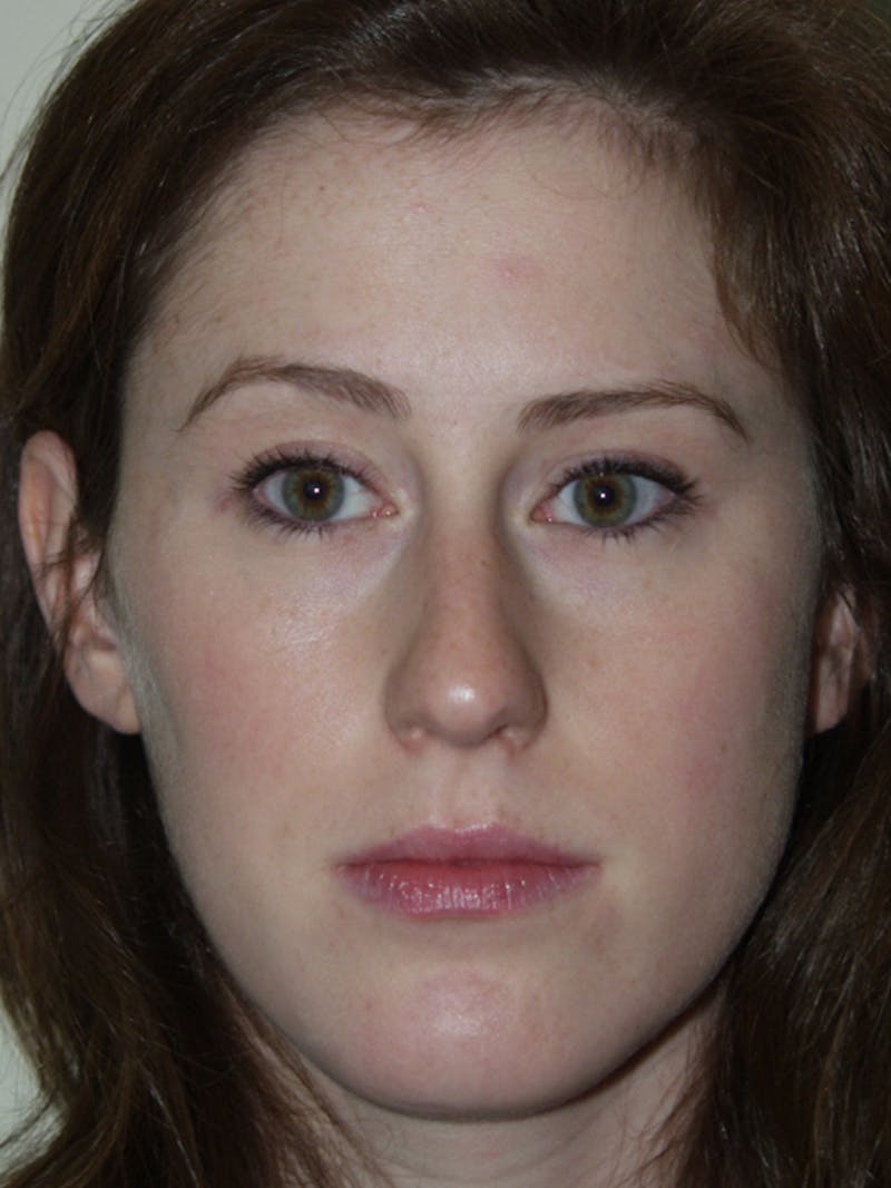 Rhinoplasty Before & After Gallery - Patient 53824005 - Image 3