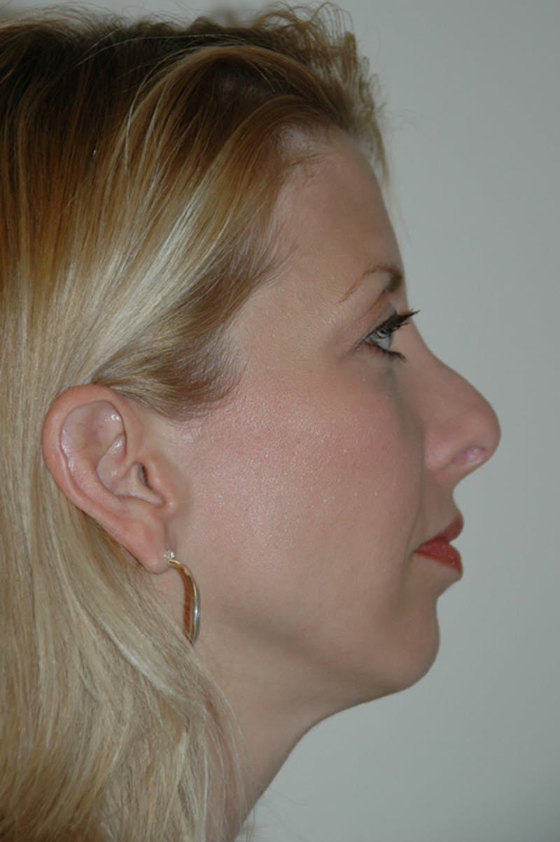Revision Rhinoplasty Before & After Gallery - Patient 54673300 - Image 1