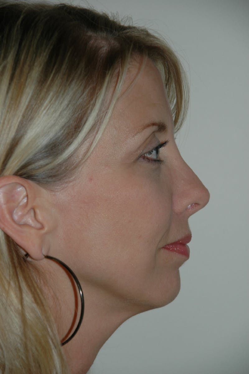 Revision Rhinoplasty Before & After Gallery - Patient 54673300 - Image 2